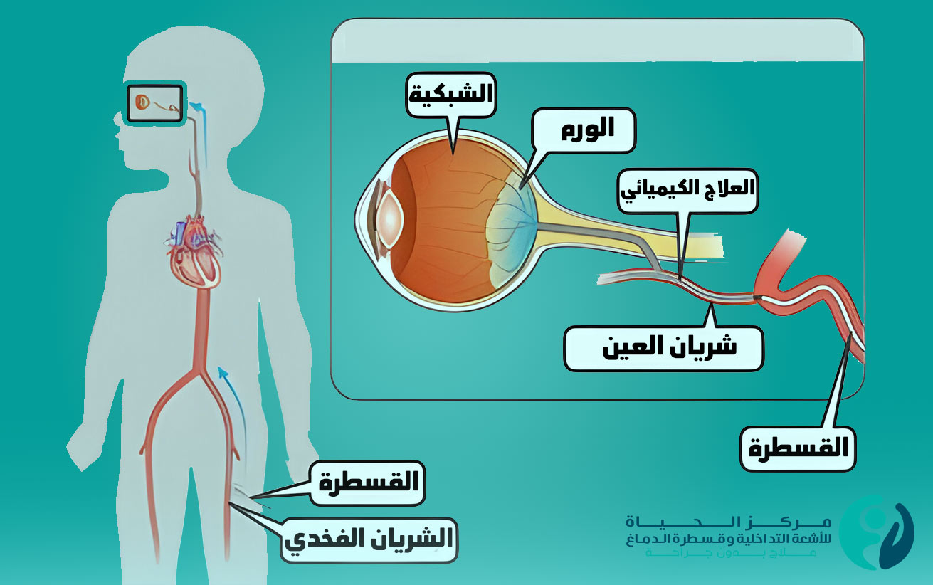 الورم الأرومي