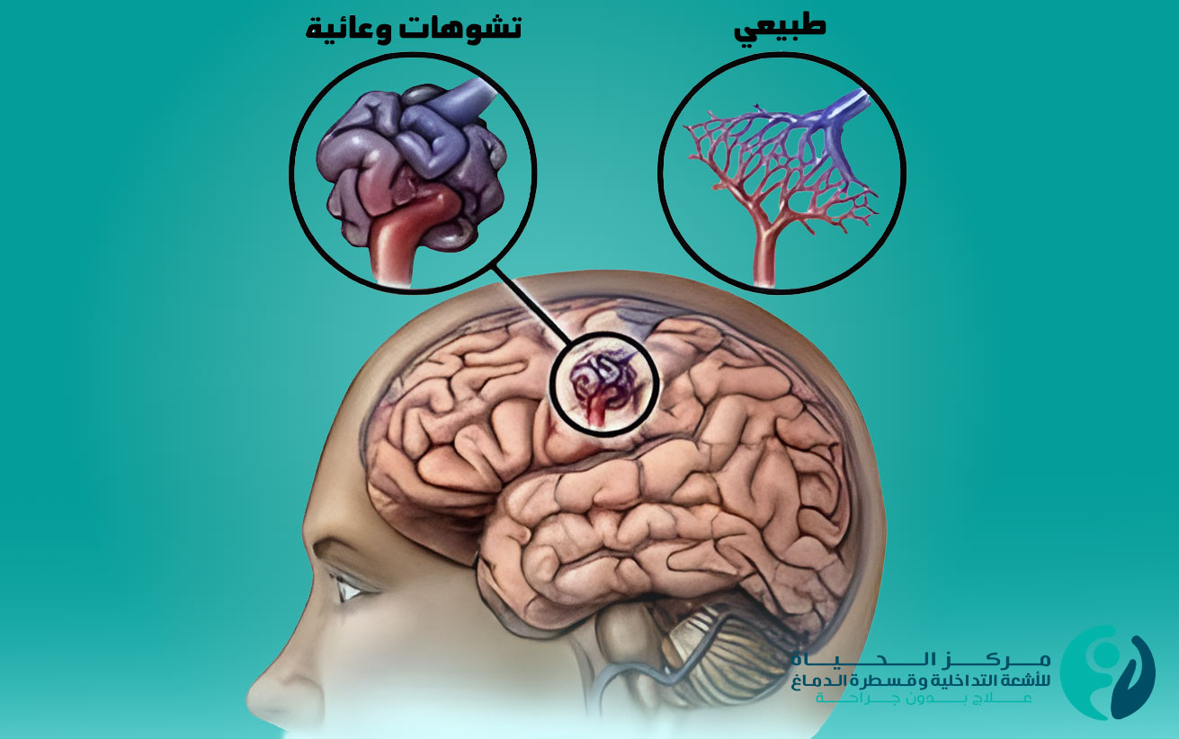 علاج تشوه الأوعية الشريانية والوريدية الدماغية