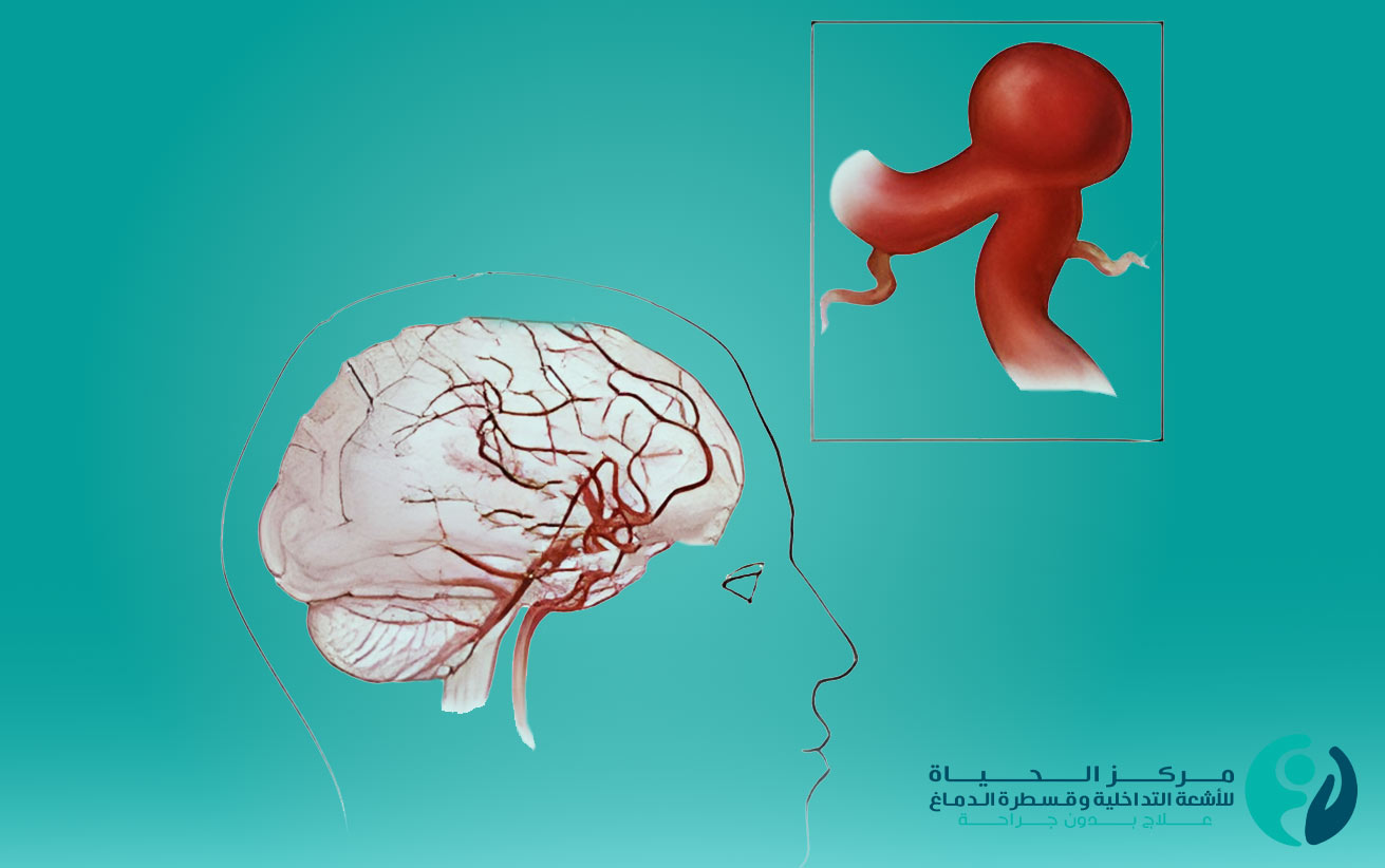 علاج تمدد شرايين الدماغ بالاشعة التداخلية