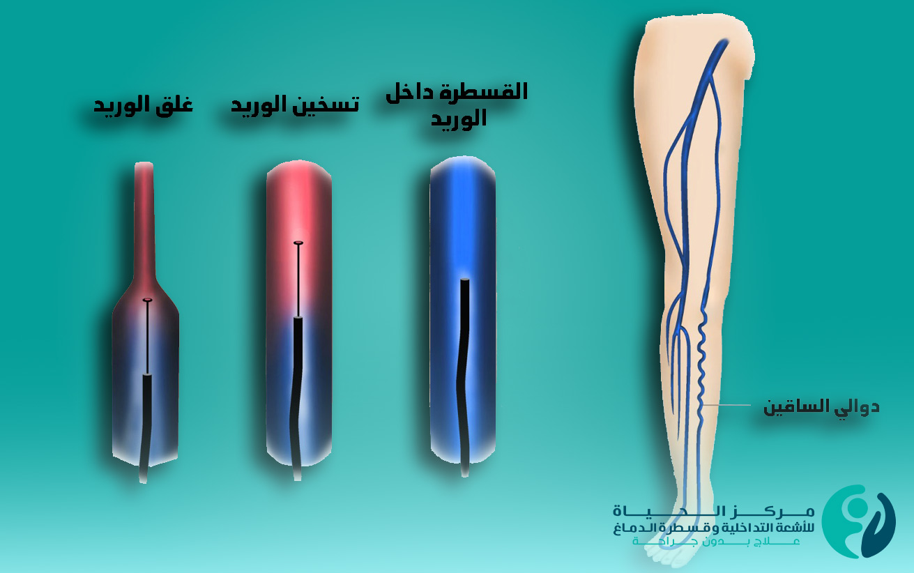 دوالي الساقين