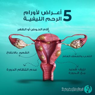 علاج-الأورام-الليفية-بالأشعة-التداخلية2