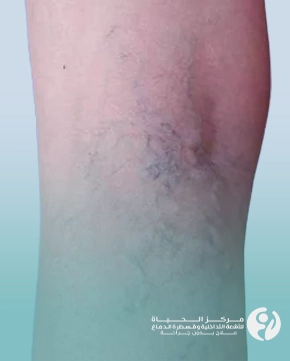 افضل مركز علاج دوالي الساقين بالعراق