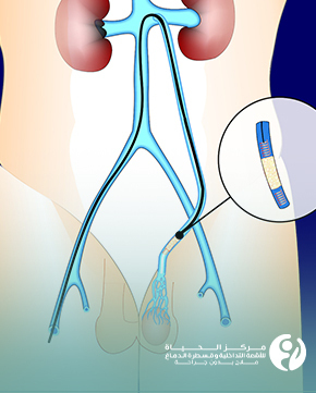 علاج دوالي الخصية بالقسطرة