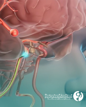 After-a-Cerebral-Catheter-Angiography