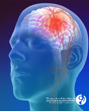 Cerebral-Catheter-Angiography