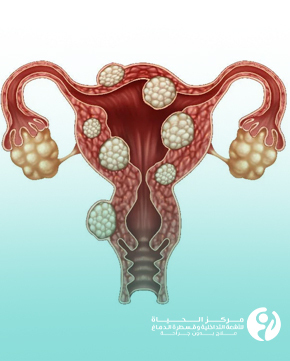 Non-Surgical-Fibroid-Treatment