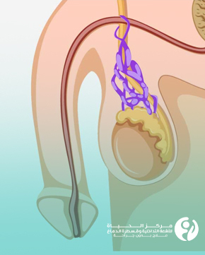 Non-surgical-treatment-of-varicocele