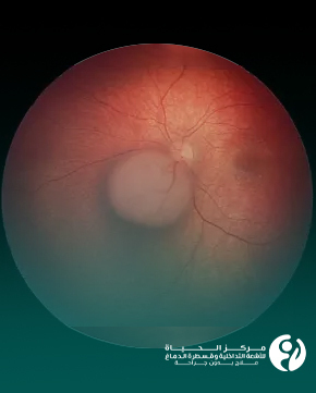 Treatment-of-Retinal-Tumors