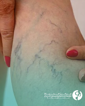 Varicose-Veins-Treatment-for-Women