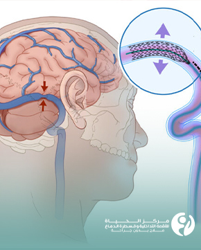 القسطرة الدماغية العلاجية