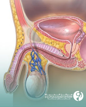 دوالي الخصية وطرق العلاج