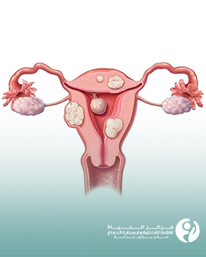 علاج الأورام الليفية في الرحم