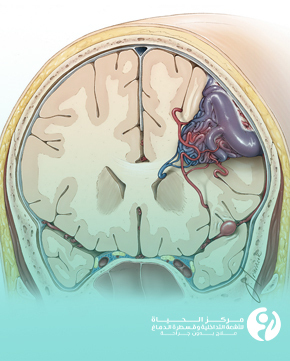 علاج التشوه الشرياني الوريدي الدماغي بالقسطرة