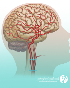 علاج انسداد شرايين الدماغ