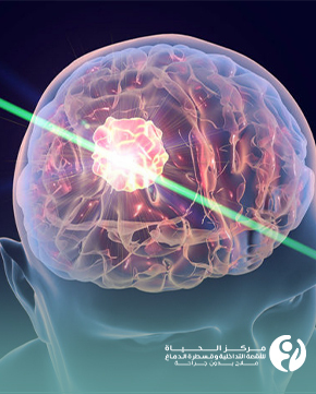 علاج اورام الدماغ بالاشعة