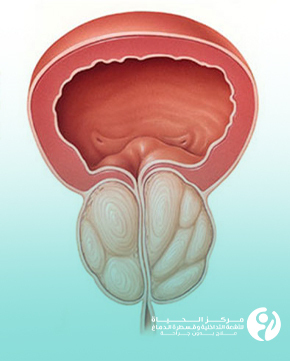 علاج تضخم البروستاتا بدون جراحة