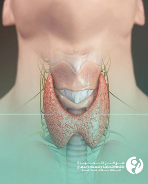 علاج تضخم الغدة الدرقية