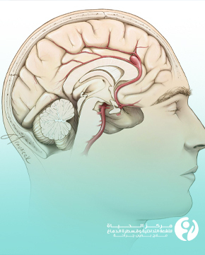 علاج تمدد شرايين المخ