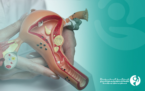 Treatment-of-Uterine-Fibroids-with-Interventional-Radiology